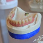 Kann die Zahnfleischerkrankung rückgängig gemacht werden?