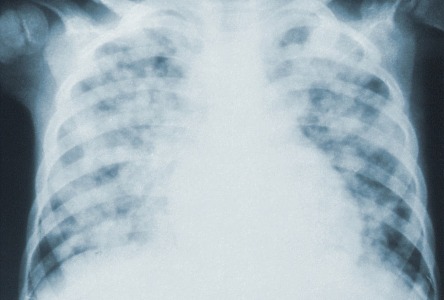 Was ist COPD?